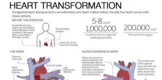 Medical infographic : Medical infographic : Medical infographic : The graphic shows the operation of a 24 year old that was …
