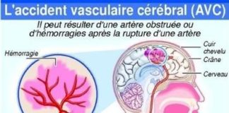 Health infographic : Prévention de l’accident vasculaire cérébral