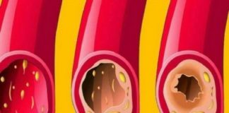 Healthcare infographic : 10 Foods That Unclog Arteries Naturally And Protect Against Heart Attack