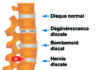 Medical infographic : Disques lombaires