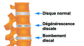 Medical infographic : Disques lombaires