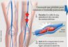 Medical infographic : Le poids sous-estimé des embolies pulmonaires