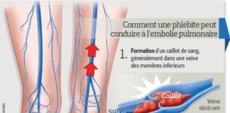 Medical infographic : Le poids sous-estimé des embolies pulmonaires