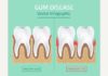 Medical infographic : Medical infographic : Medical infographic : Gum Disease Stages. Medical Infographic. $3.00