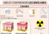 Medical infographic : Mieux comprendre les brûlures avec les différentes causes