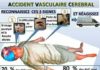 Science infographic – Science infographic – Accident vasculaire cérébrale
