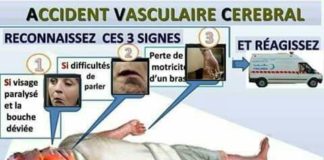 Science infographic – Science infographic – Accident vasculaire cérébrale
