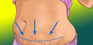 Health infographic : 5 Easy Ways To Get Rid Of Sagging Skin After Weight Loss