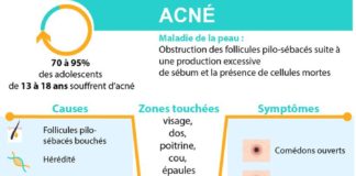 Health infographic : Acné : causes, symptômes & traitements | Creapharma