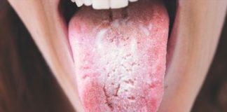 Health infographic : What Is Candida Overgrowth And How To Deal With It