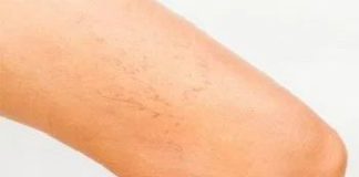 Healthcare infographic : 4 Effective Ways to Prevent Varicose Veins – Something Logical