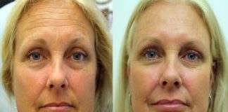 Healthcare infographic : Ladies, This 2 Ingredients Face Lift Mask Will Remove All Wrinkles From Your Neck And Entire Skin. H