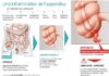 Medical infographic : Appendicite : le difficile diagnostic qui complique tout