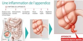 Medical infographic : Appendicite : le difficile diagnostic qui complique tout
