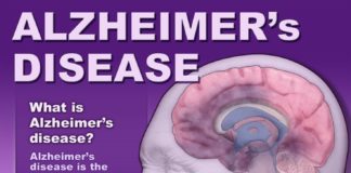 Medical infographic : Medical infographic : #Alzheimer’s disease is the most common cause of the syndrome that doctors call …