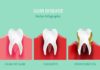 Medical infographic : Medical infographic : Gum disease stages. Medical Infographic. $3.00