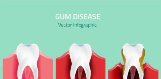 Medical infographic : Medical infographic : Gum disease stages. Medical Infographic. $3.00