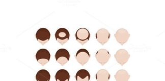 Medical infographic : Medical infographic : Medical infographic : Type of baldness. Medical Infographic. $9.00