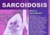 Medical infographic : Sarcoidosis Infographic from Mount Sinai www.mountsinai.or… Check more at http://dratef.net…