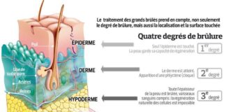 Science infographic – Science infographic – Grands brûlés : le défi de la peau de remplacement