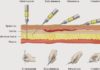 Science infographic – Medical infographic : injections parentérales infirmier angle technique