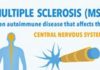 Statistics infographic : Everything You Need to Know About Multiple Sclerosis (MS)