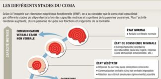 Educational infographic : Les différents stades du coma