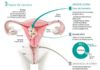 Science infographic – Le cancer de l’utérus ne doit pas être négligé