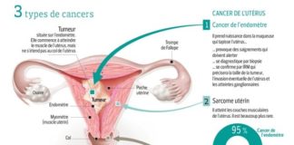 Science infographic – Le cancer de l’utérus ne doit pas être négligé