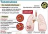 Science infographic – Science infographic – Tuberculose et antibiorésistance : des chercheurs lillois inventent un nouveau prototype de médicament