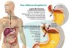 Medical infographic : Des stratégies efficaces contre le reflux gastrique