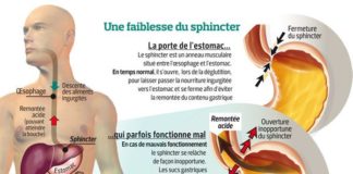 Medical infographic : Des stratégies efficaces contre le reflux gastrique