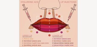 Medical infographic : Lips Injections Image. Medical Infographic