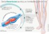 Medical infographic : Phlébites, embolies : un danger mal connu