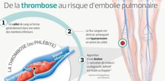 Medical infographic : Phlébites, embolies : un danger mal connu