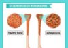 Medical infographic : Scientific medical infographic of osteoporosis of bones Premium Vector | Premium…