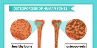 Medical infographic : Scientific medical infographic of osteoporosis of bones Premium Vector | Premium…