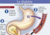 diabetes infographic – Le diabète de type 2.